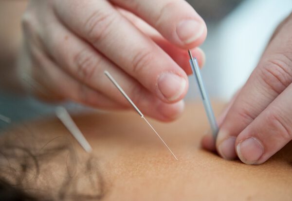 Schmerzfrei durch Akupunktur: Deine Schritte zu einem besseren Lebensgefühl